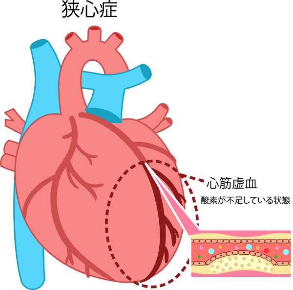 狭心症はどんな病気？